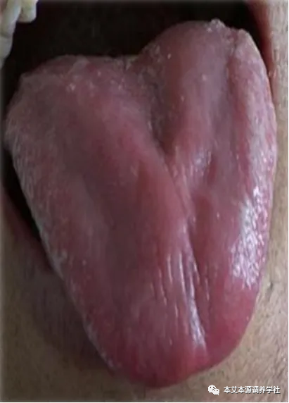 Tongue Diagnosis Series 3: Precise Differentiation of Tongue Coating, Quality, and Shape