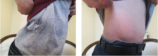 Understanding Fire Needle Therapy in Traditional Chinese Medicine