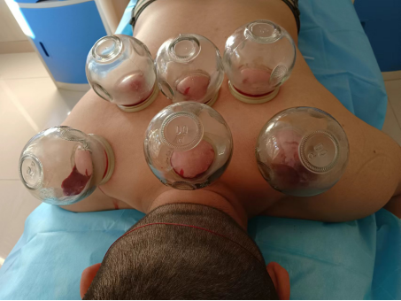 Traditional Chinese Medicine Therapy: Bloodletting Therapy
