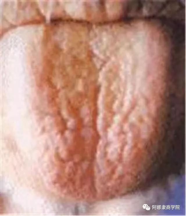 A Comprehensive Guide to 22 High-Definition Tongue Diagnosis Images: Understand Diseases Through Tongue Observation!