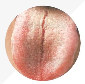Understanding Tongue Diagnosis in TCM: Insights into Health from Tongue Appearance (Part 2)