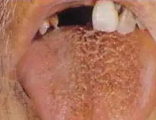The Most Comprehensive Guide to Tongue Diagnosis! Master It and Become a Tongue Diagnosis Expert