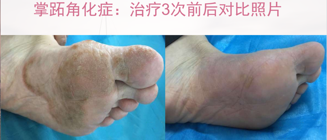 Essential Knowledge of Fire Needle Therapy in Dermatology