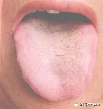 Tongue Diagnosis in Traditional Chinese Medicine: Characteristics of Tongue Coating