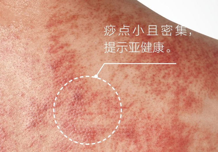 Understanding the Signs of Gua Sha: Master These 5 Colors and 4 Shapes for Better Health