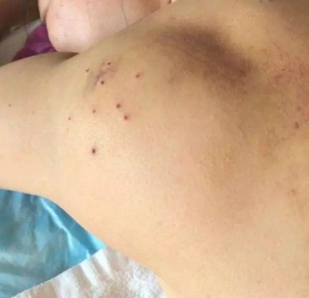 Fire Needle Therapy for Large Lipomas