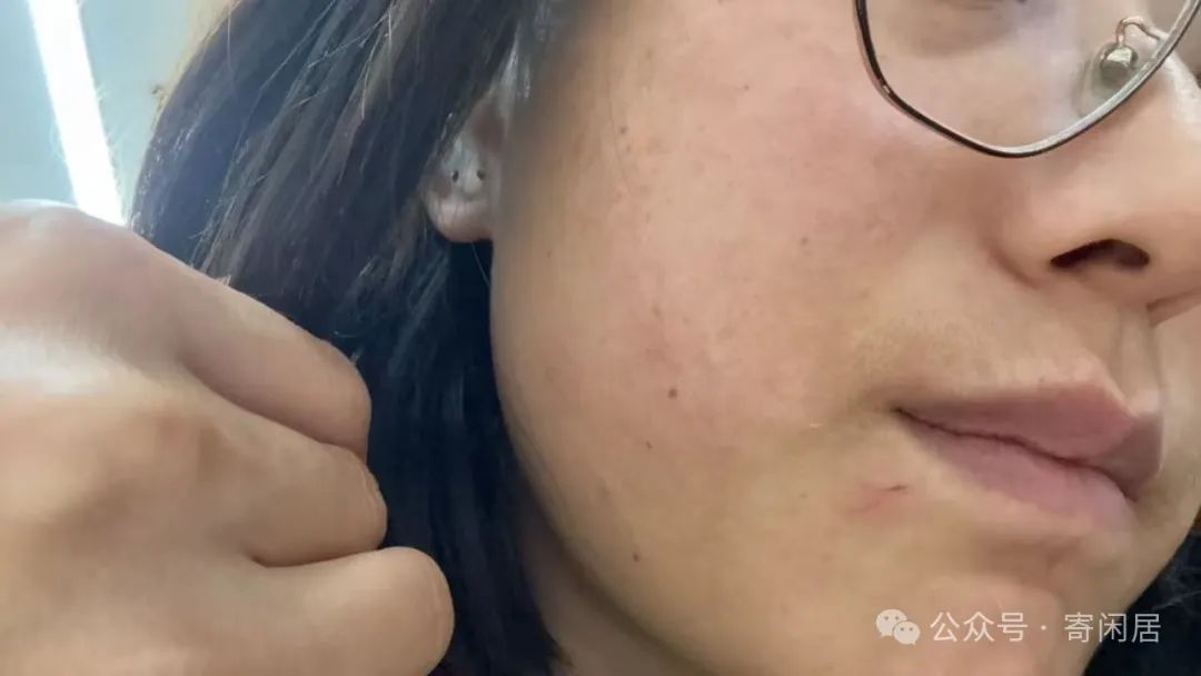 Case Study 001: Damp-Heat Accumulation Causing Skin Rash (Including Treatment Principles for Skin Diseases)