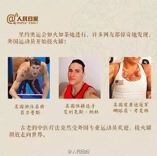 Cupping Therapy Gained Popularity at the Rio Olympics! But Not Everyone is Suitable for Cupping