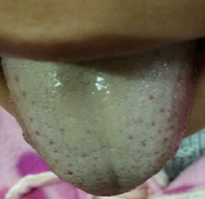 Analysis of Clinical Patterns and Treatments for Summer Damp-Heat Syndrome (6): Typical Damp-Heat Case Studies