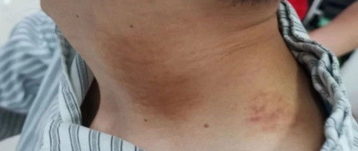 Man Suffers Stroke After Massage and Gua Sha at Home; This Area Should Not Be Massaged Casually