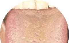 When Your Tongue Shows This Signal: Don't Delay!