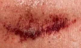 Understanding the Signs of Gua Sha: Master These 5 Colors and 4 Shapes for Better Health