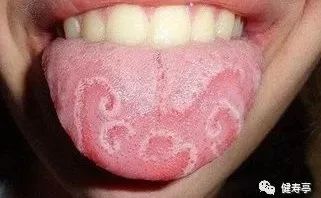 Understanding Tongue Diagnosis in Traditional Chinese Medicine (with Tongue Diagnosis Illustrations)