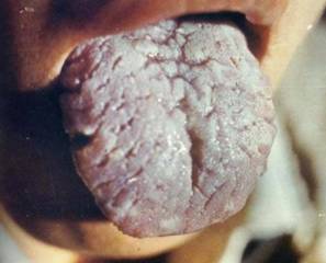 Comprehensive Guide to Tongue Diagnosis: Easily Understand Your Health Condition