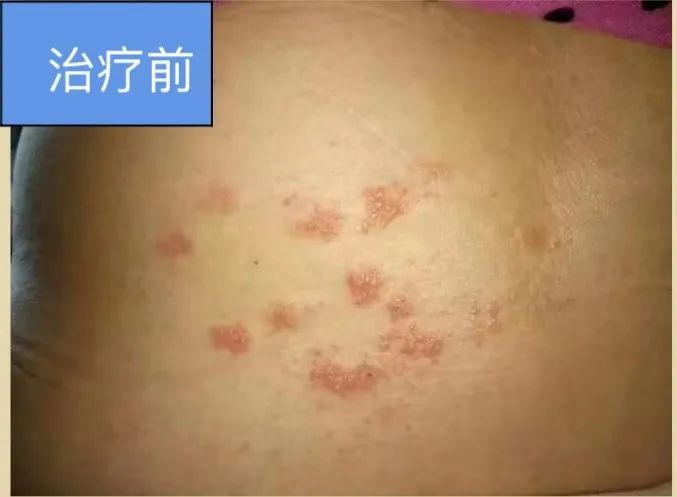 Dermatology: TCM Fire Needle Technique for Treating Skin Diseases