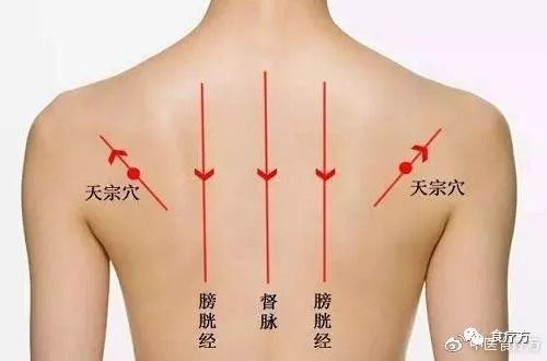 Comprehensive Guide to Cupping Therapy for the Back