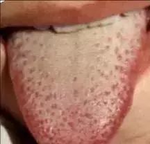The Most Comprehensive Guide to Tongue Diagnosis! Master It and Become a Tongue Diagnosis Expert