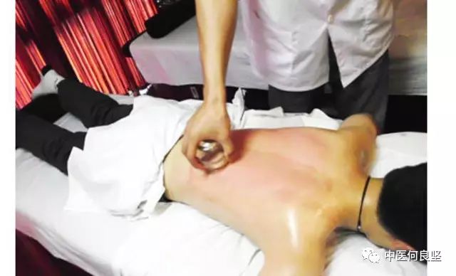 Cupping Therapy for Obesity