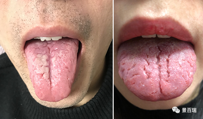Basic Tongue Diagnosis - Tongue Body and Tongue Coating