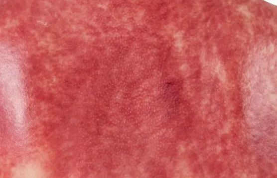 Understanding the Signs of Gua Sha: Master These 5 Colors and 4 Shapes for Better Health
