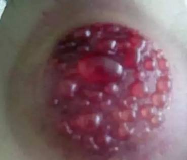 Why Cupping Can Cause Blisters and Blood Blisters