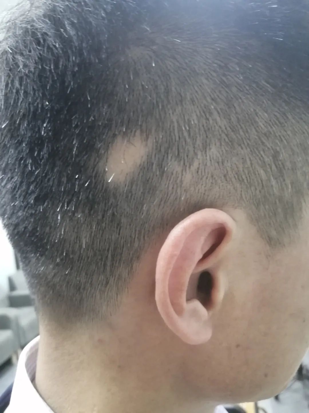 The Treasure of TCM in Treating Alopecia Areata