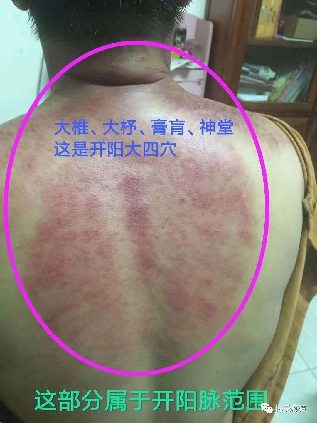 Key Points of Gua Sha