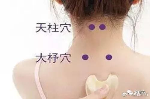 Comprehensive Guide to Cupping Therapy for the Back