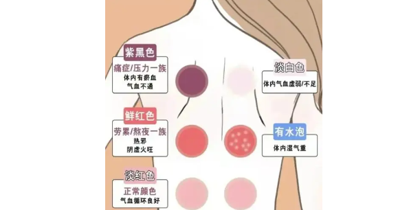 Cupping Therapy: A Traditional Chinese Medicine Approach to Health