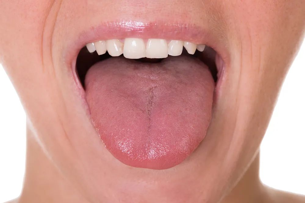 What Causes a Thick White Coating on the Tongue?