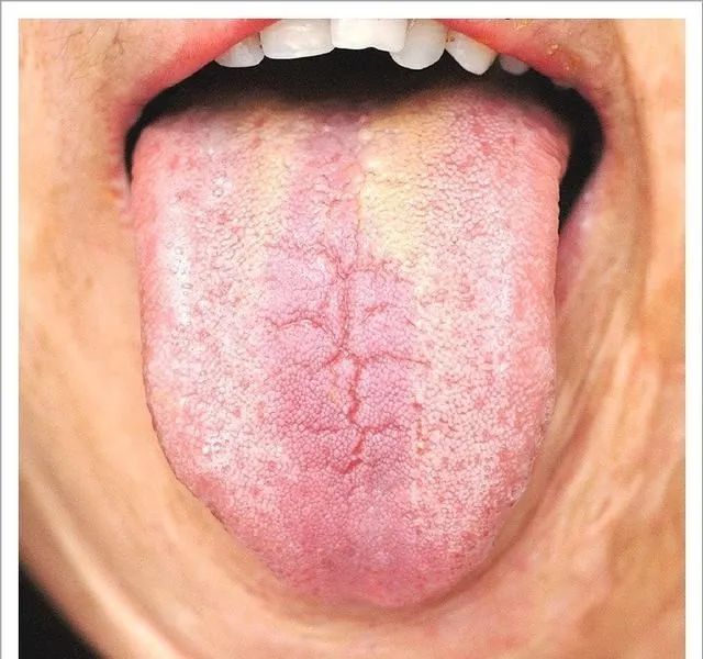 Traditional Chinese Medicine Tongue Diagnosis: 26 Clinical High-Definition Tongue Diagnosis Images with Analysis