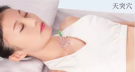Cupping Therapy for Cold Symptoms