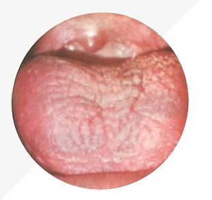 Understanding Tongue Diagnosis in TCM: Insights into Health from Tongue Appearance (Part 2)