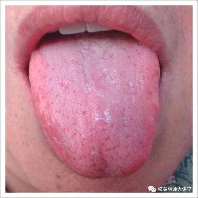 Traditional Chinese Medicine Tongue Diagnosis: Illustrated Guide to 14 Types of Tongue Shapes and Qualities