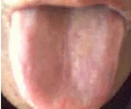 Symptoms and Dietary Remedies for Blood Deficiency, Blood Stasis, Blood Cold, and Blood Heat