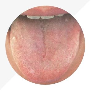 Understanding Tongue Diagnosis in TCM: Insights into Health from Tongue Appearance (Part 2)