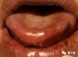 The Health Code Hidden on Your Tongue