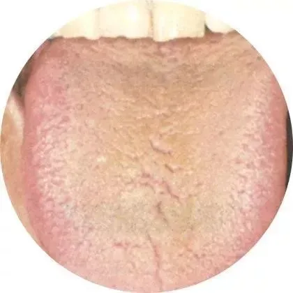 When Your Tongue Shows This Signal: Go to the Hospital Immediately, Don't Delay!