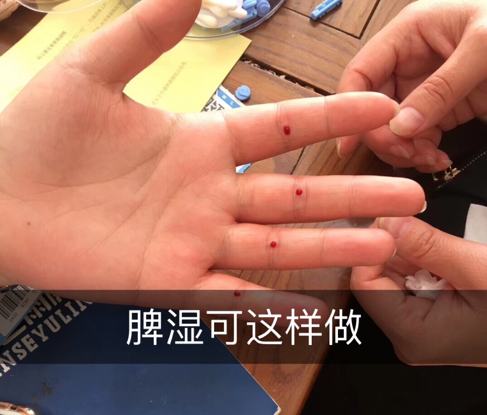 Utilizing the Four Seam Points for Bloodletting: Enhancing Appetite and Clearing Heat to Unblock Meridians