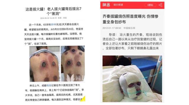 Man Gets Stuck in Cupping Therapy! Firefighters Called for Rescue... Would You Dare to Try It?