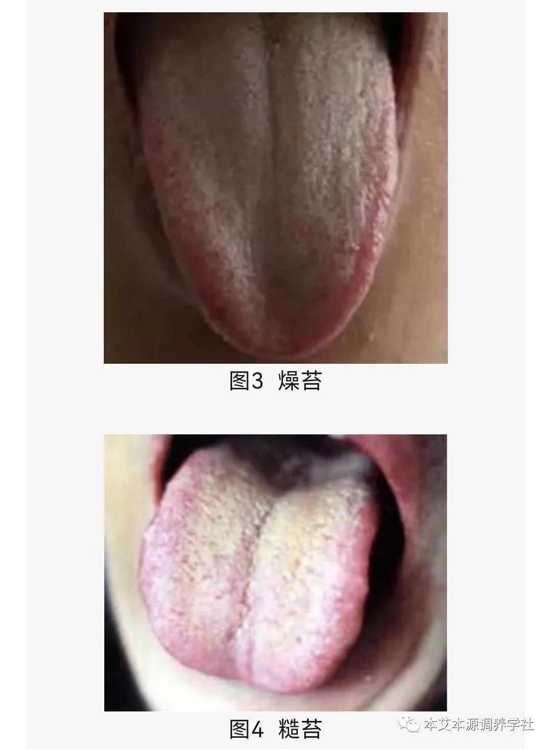 Tongue Diagnosis Series 3: Precise Differentiation of Tongue Coating, Quality, and Shape