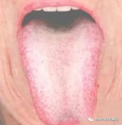 Tongue Diagnosis in Traditional Chinese Medicine: Characteristics of Tongue Coating
