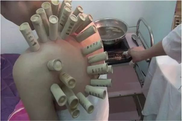 Is Phelps' Cupping a Victory for Traditional Chinese Medicine? Don't Be Overconfident