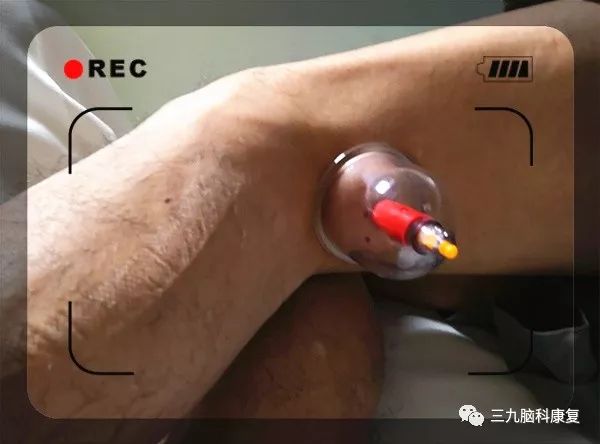 The Wonders of Bloodletting Therapy in Traditional Chinese Medicine