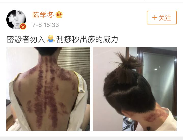 Caution: A Male Celebrity's Bare Back Photo Startles Netizens - Important Tips for Gua Sha This Summer