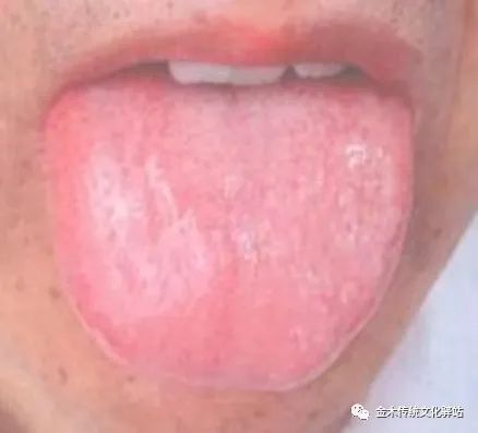 Tongue Diagnosis in Traditional Chinese Medicine: Tongue Coating