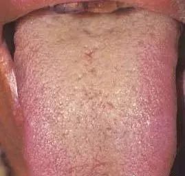 Understanding Tongue Diagnosis in Traditional Chinese Medicine (with Tongue Diagnosis Illustrations)