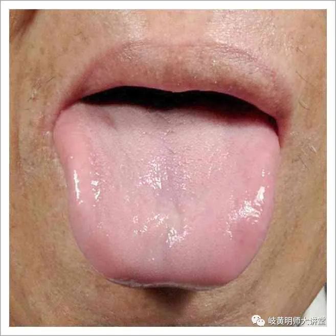 Traditional Chinese Medicine Tongue Diagnosis: Illustrated Guide to 14 Types of Tongue Shapes and Qualities