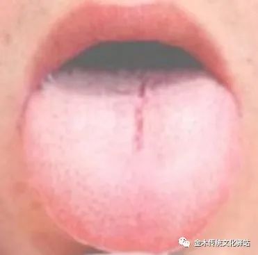 Tongue Diagnosis in Traditional Chinese Medicine: Characteristics of Tongue Coating