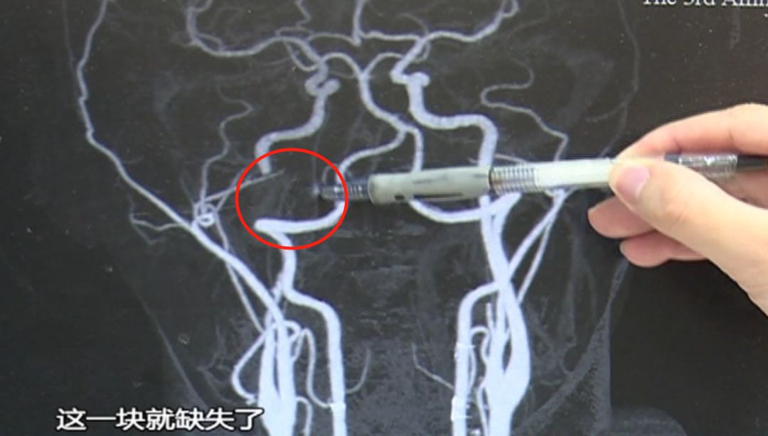 Man Suffers Stroke After Massage and Gua Sha at Home; This Area Should Not Be Massaged Casually